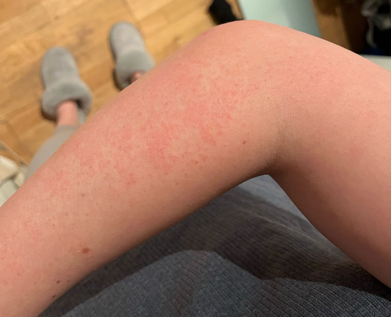 Da li vam ruke užasno pocrvene zimi? Možda imate alergiju na hladnoću! 1 IMG 20250223 WA0009 e1740312185150